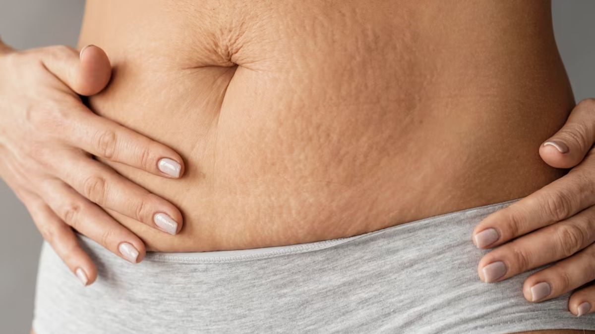 remove-stretch-marks-easily-with-these-top-5-natural-remedies